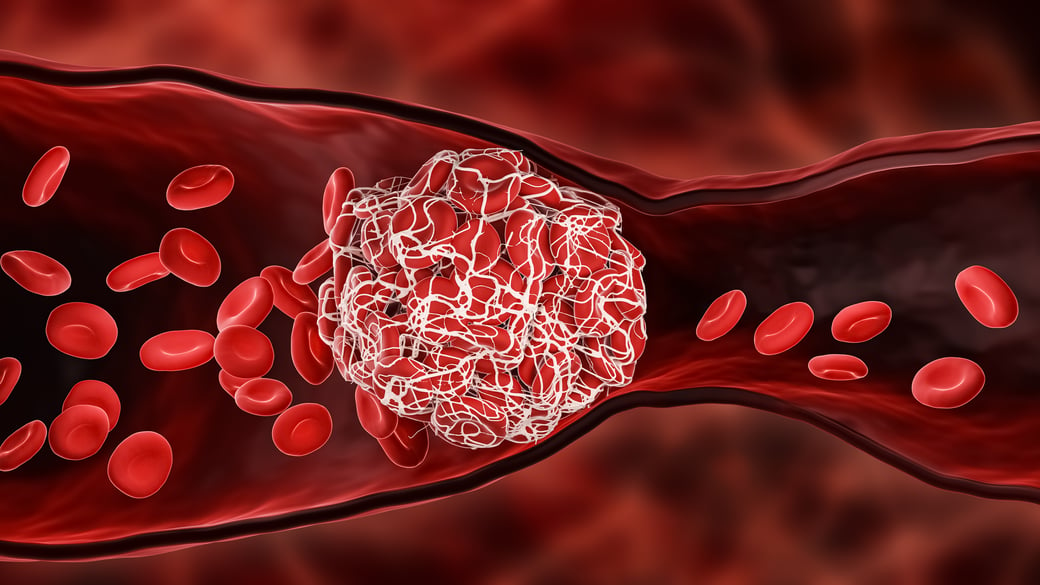 Blood clot among red blood cells